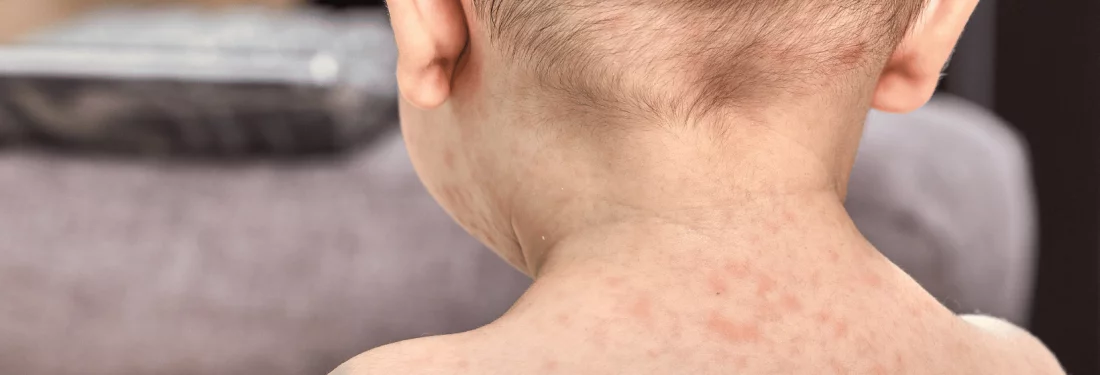 Allergia okozta bőrtünetek