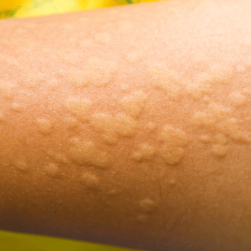 Allergia okozta bőrtünetek, Gyermekgyógyászati Központ